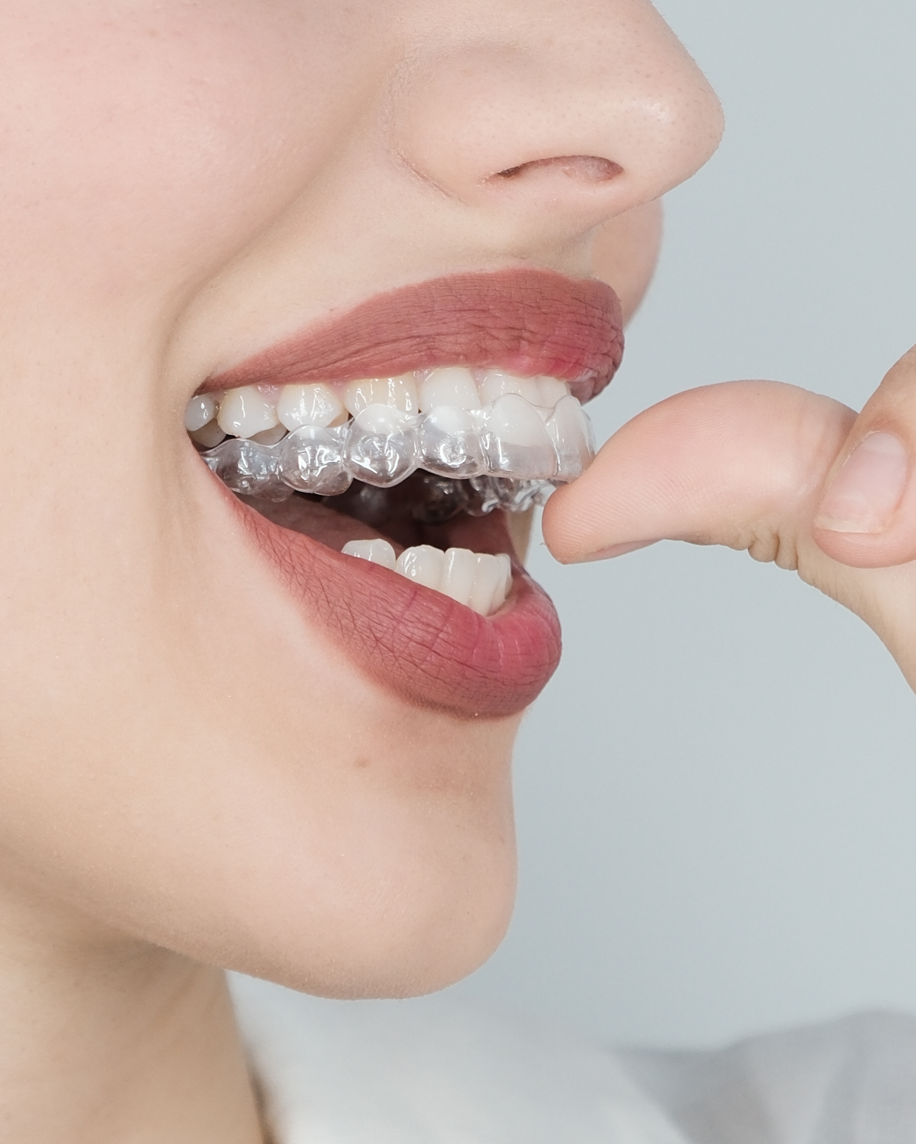 Clear Aligner Treatment