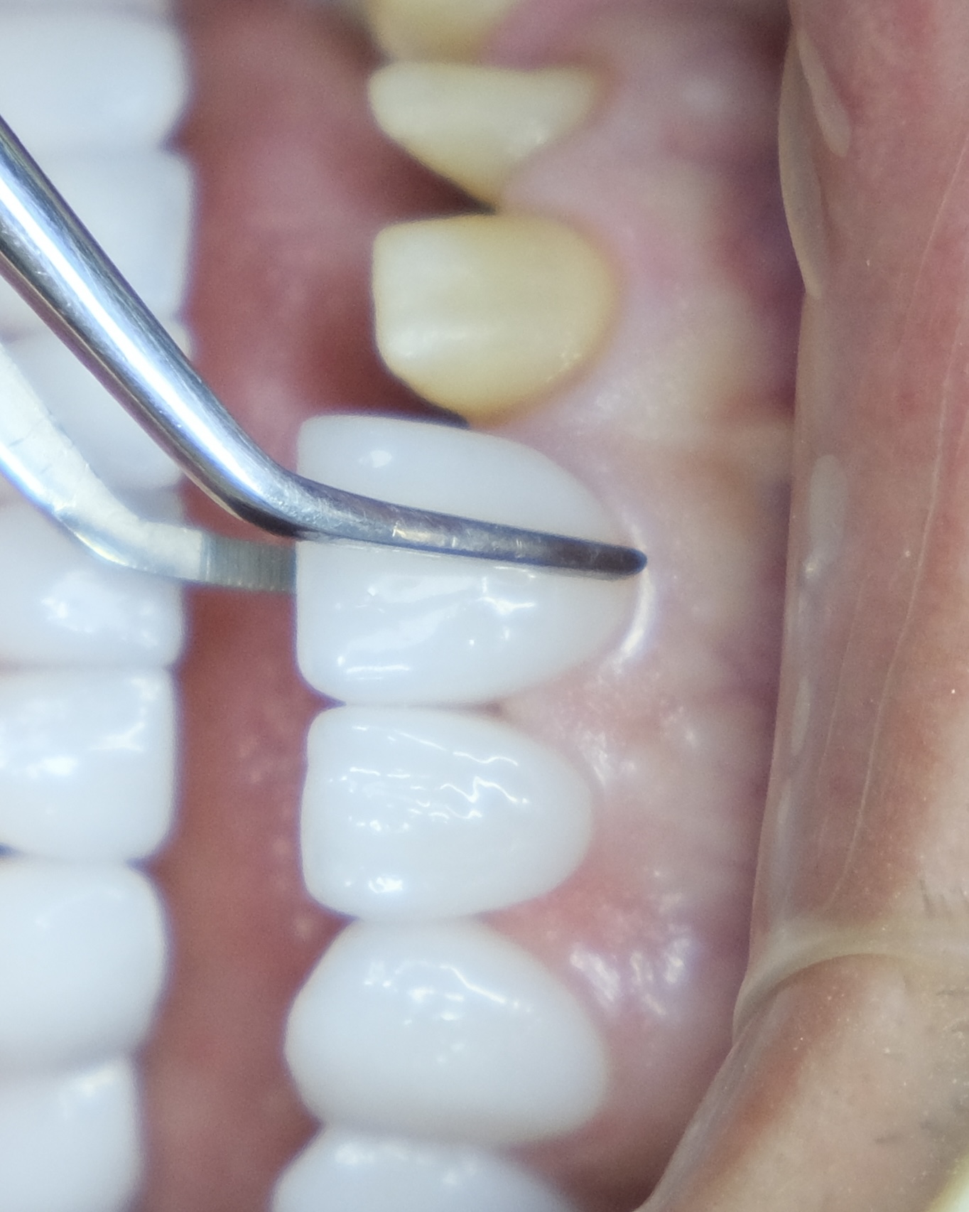 Detailed Prosthetic Examination