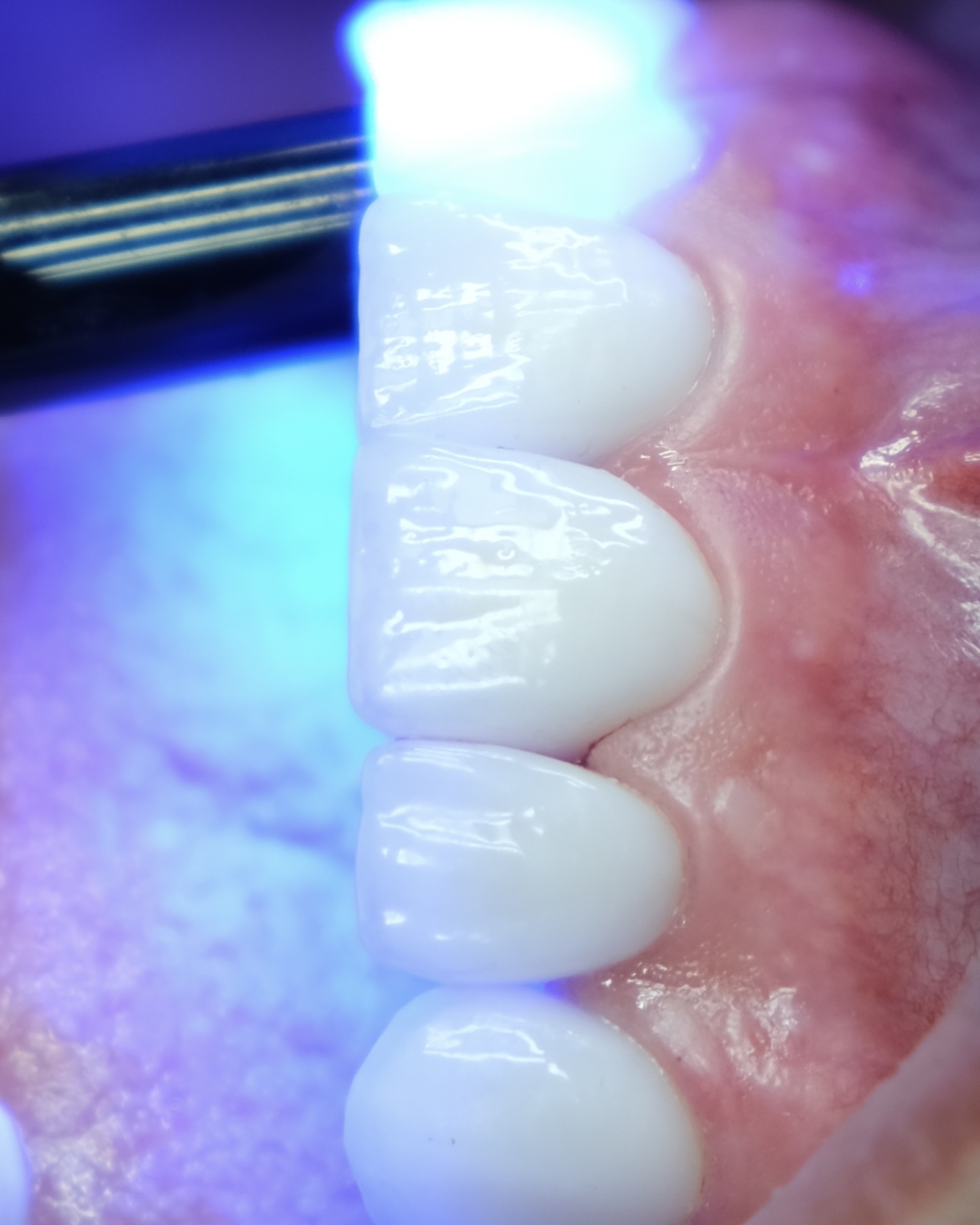 Precision Light Curing for Prosthetics