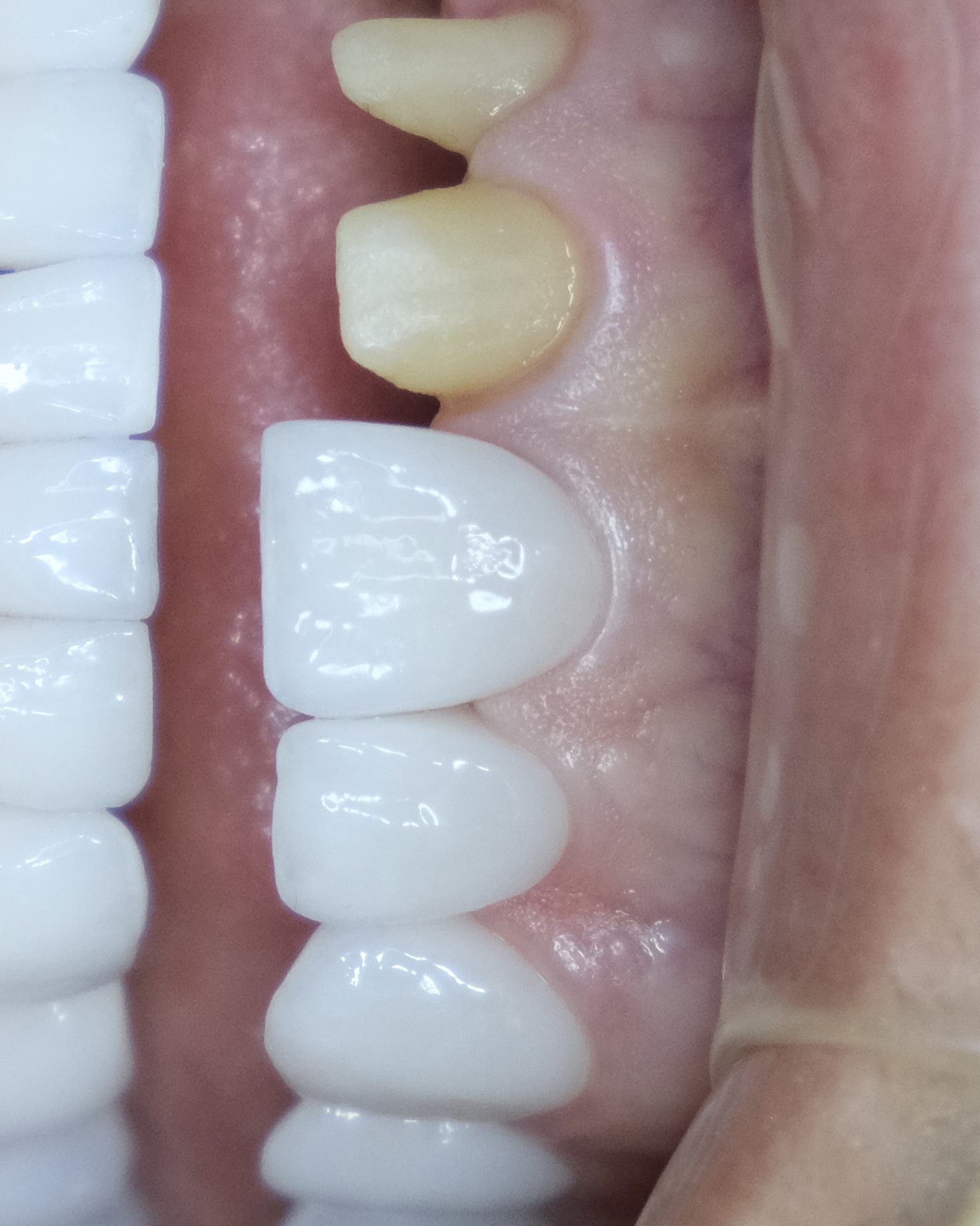 Exceptional Prosthetic Results