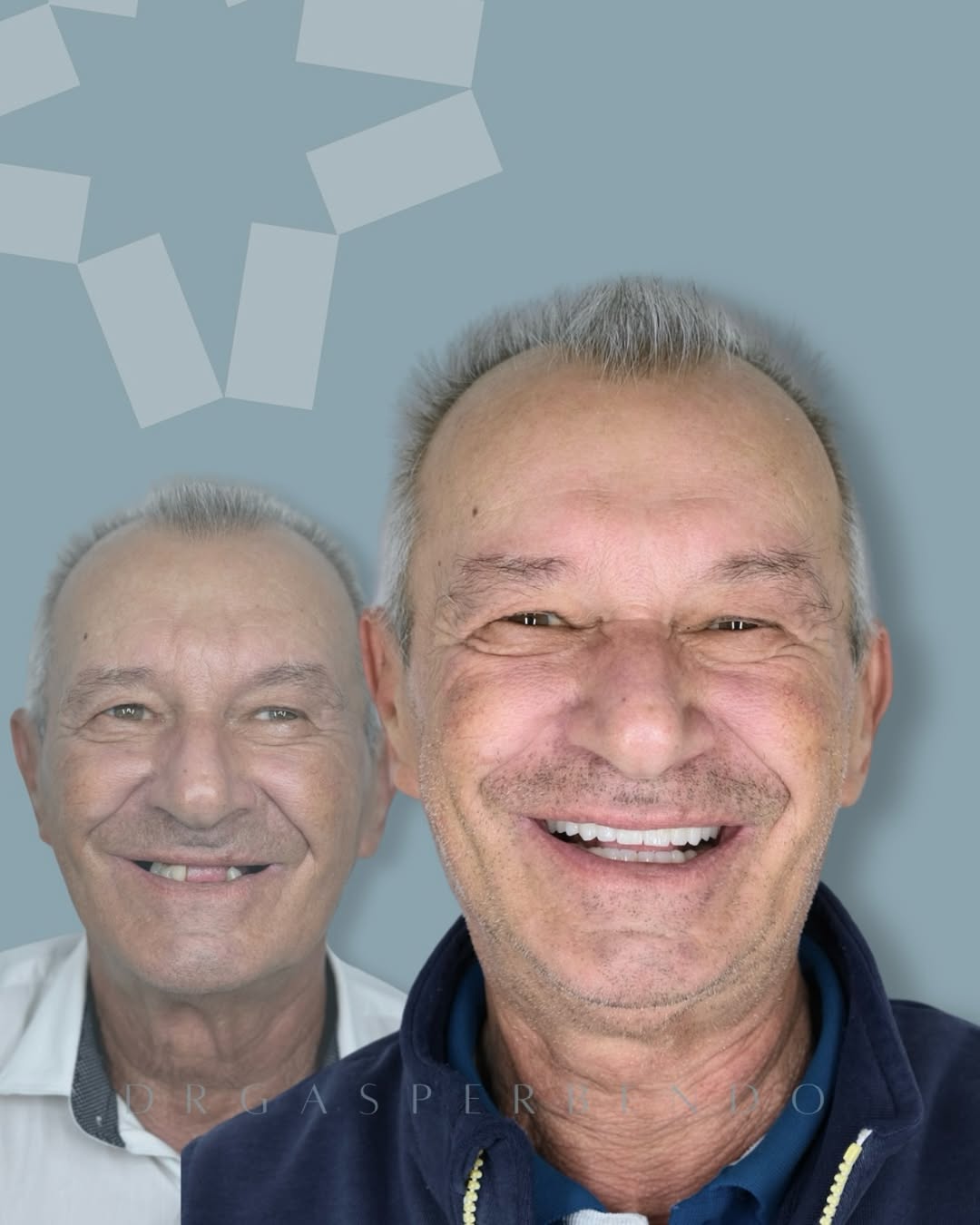 12 impianti in titanio. Sorriso ricostruito in 3 giorni. Una vita trasformata.
