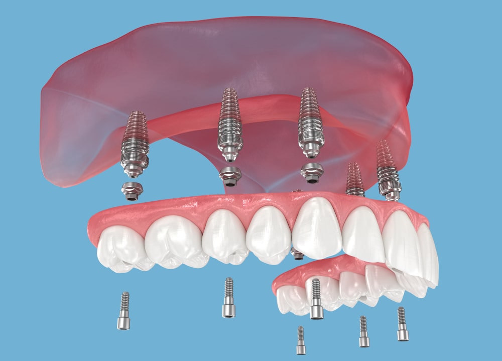 Protesi All-on-6 — European Dental Clinic Tirana