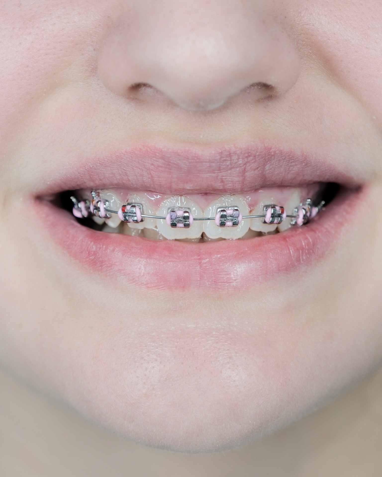 Ortodonzia fissa — brackets