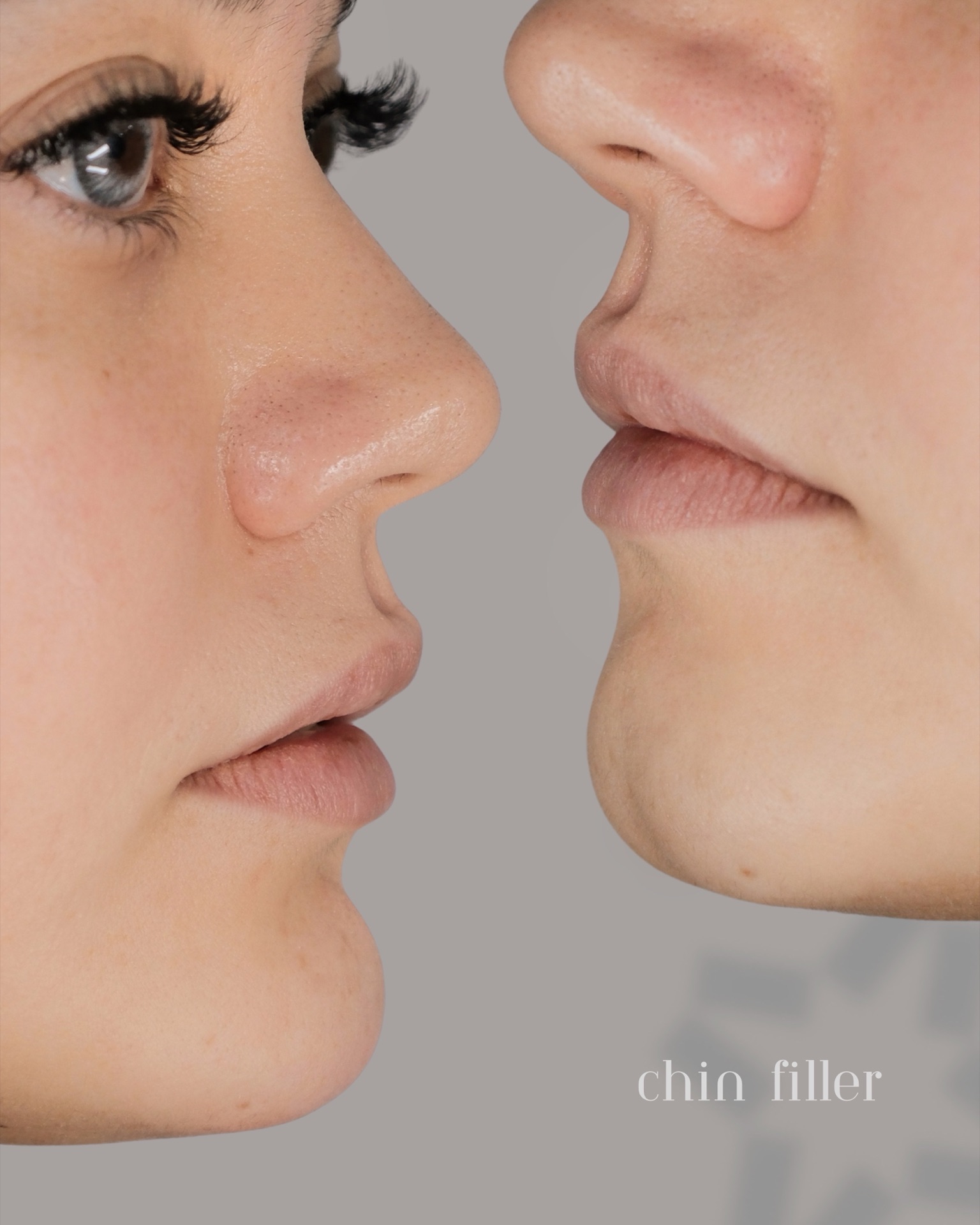 Chin filler prima e dopo — Dr. Sindi Bendo