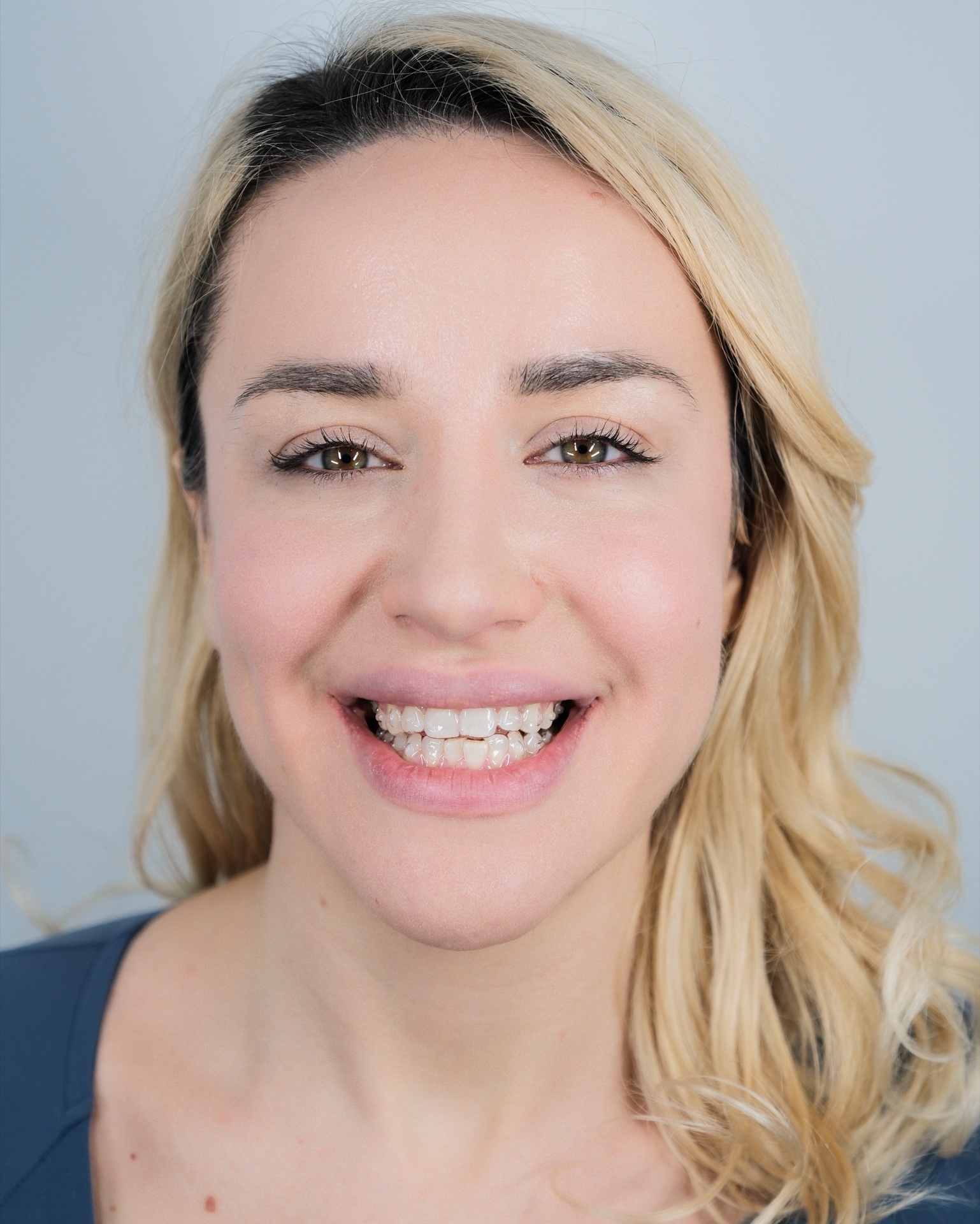 Dena con allineatori Nuvola — European Dental Clinic Tirana
