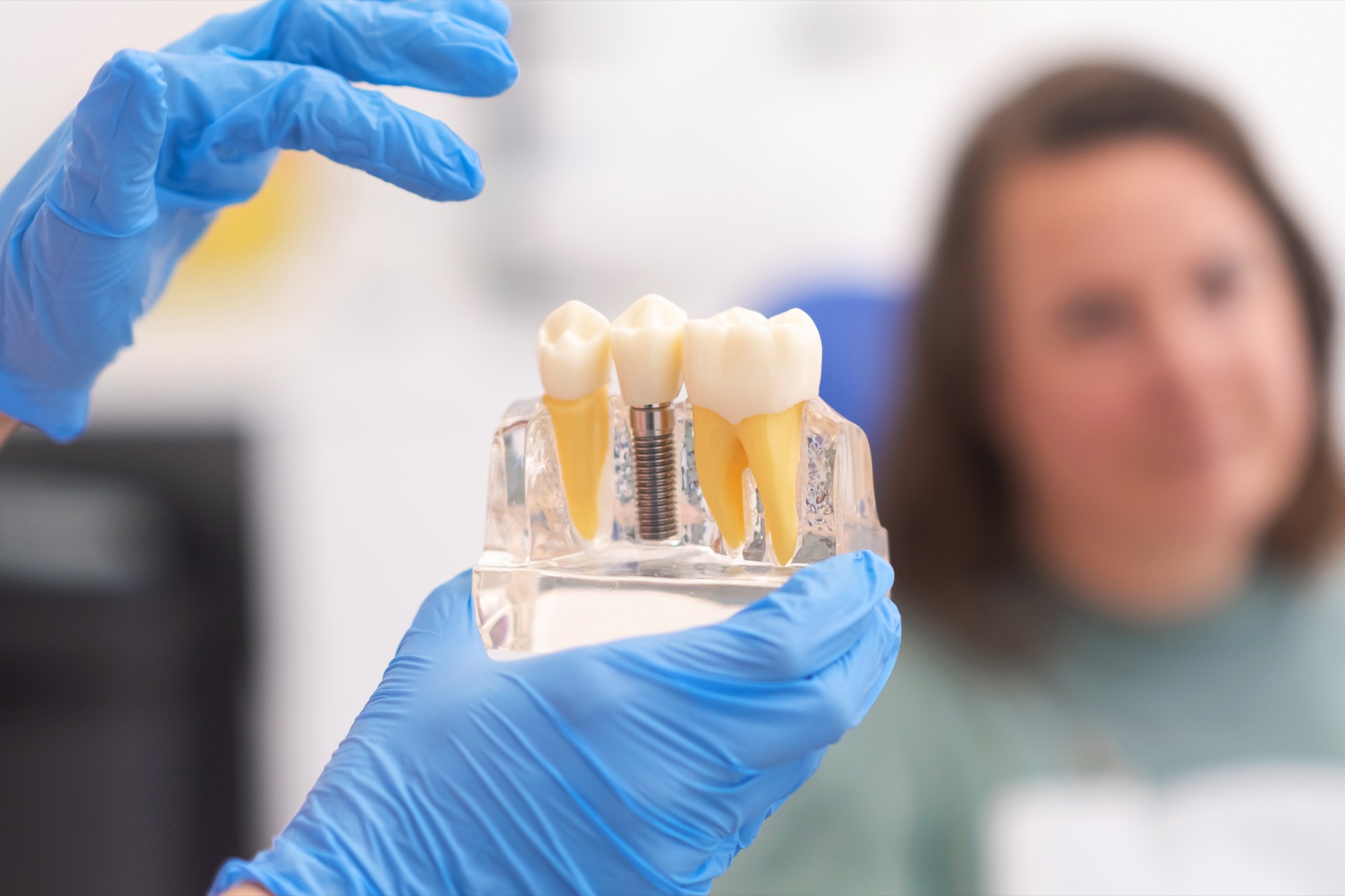 Modello di impianto dentale — All-on-4 in Albania, European Dental Clinic