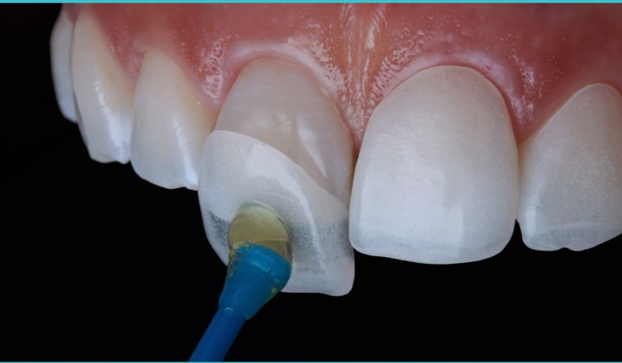 Faccette dentali eMax — European Dental Clinic Tirana
