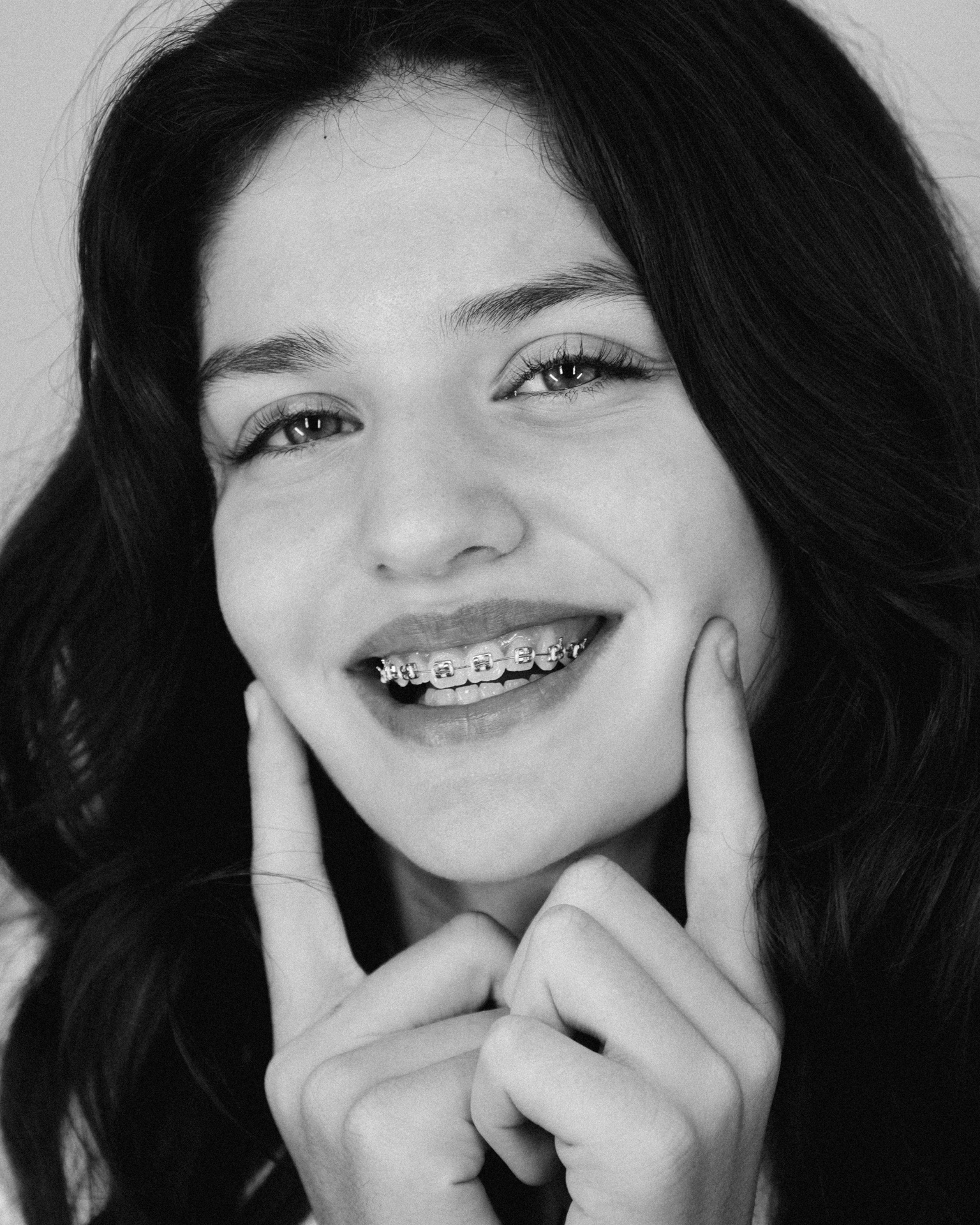 Fladia — Sorriso con brackets