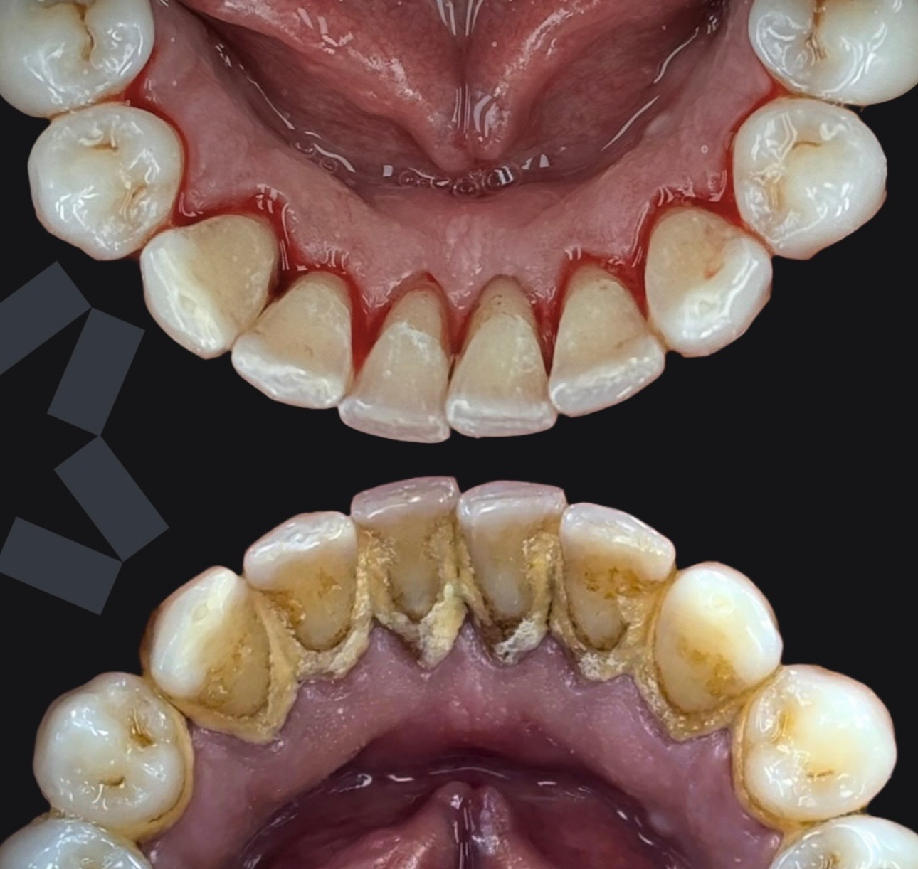 Pulizia Dentale Prima e Dopo — European Dental Clinic