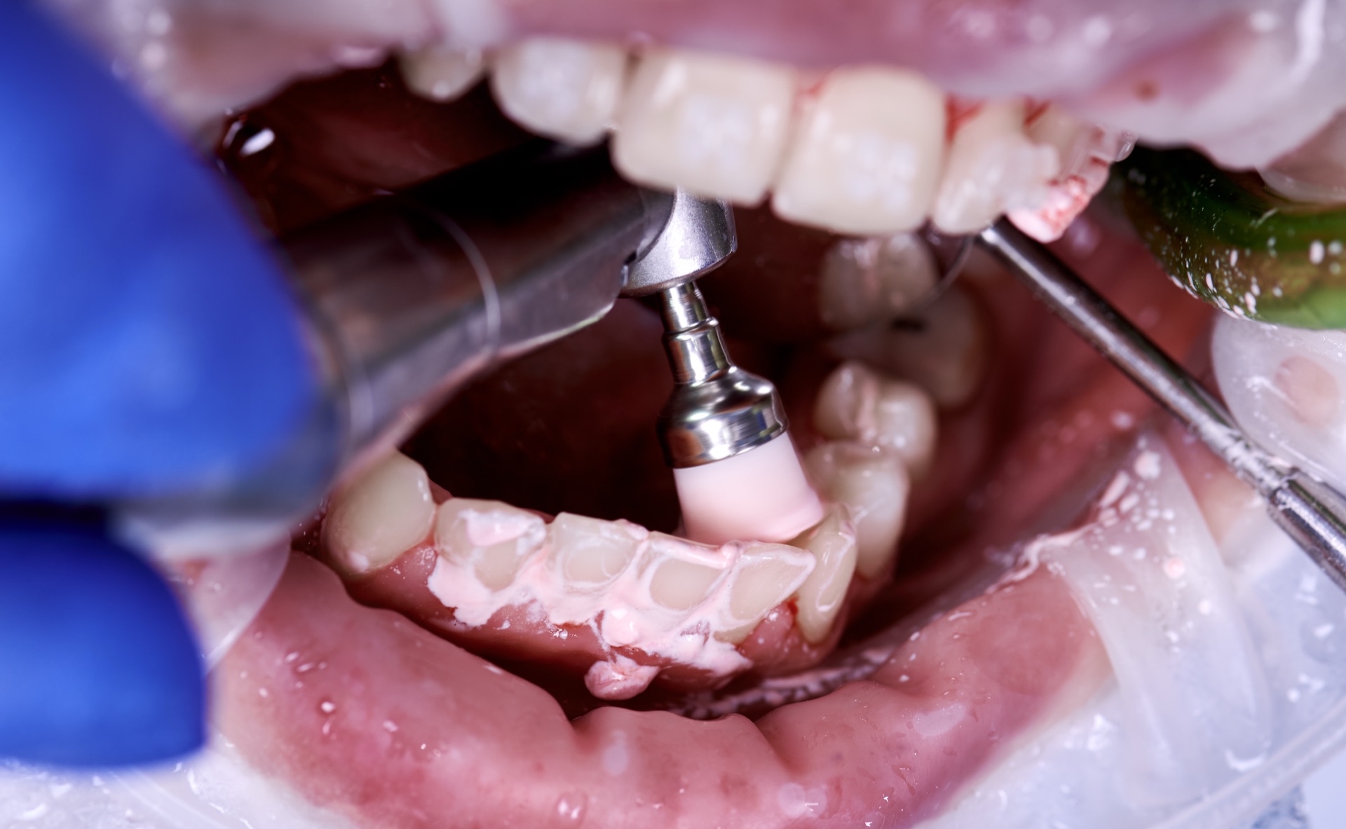 Controllo con specchio — European Dental Clinic