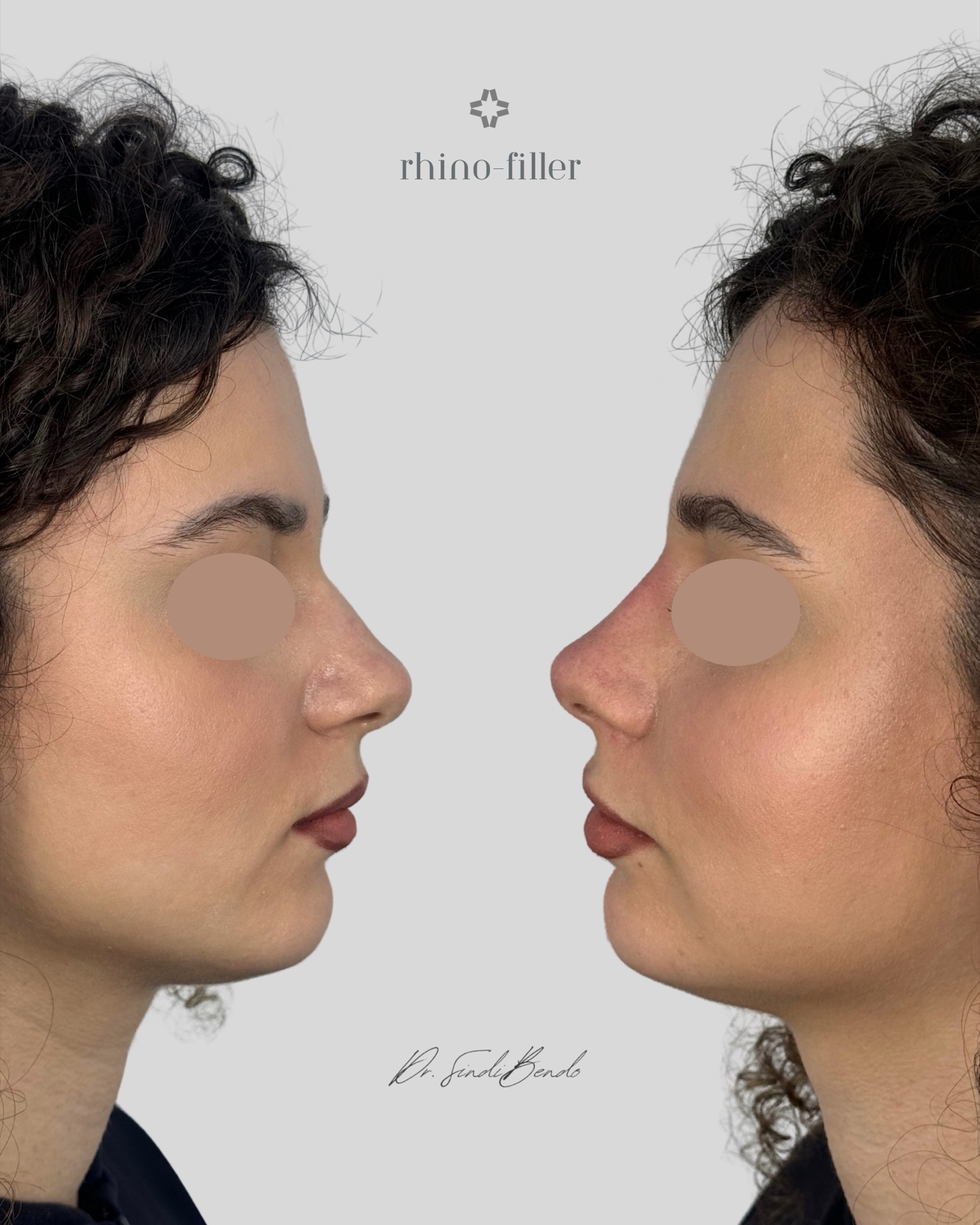 Rinofiller prima e dopo — Dr. Sindi Bendo
